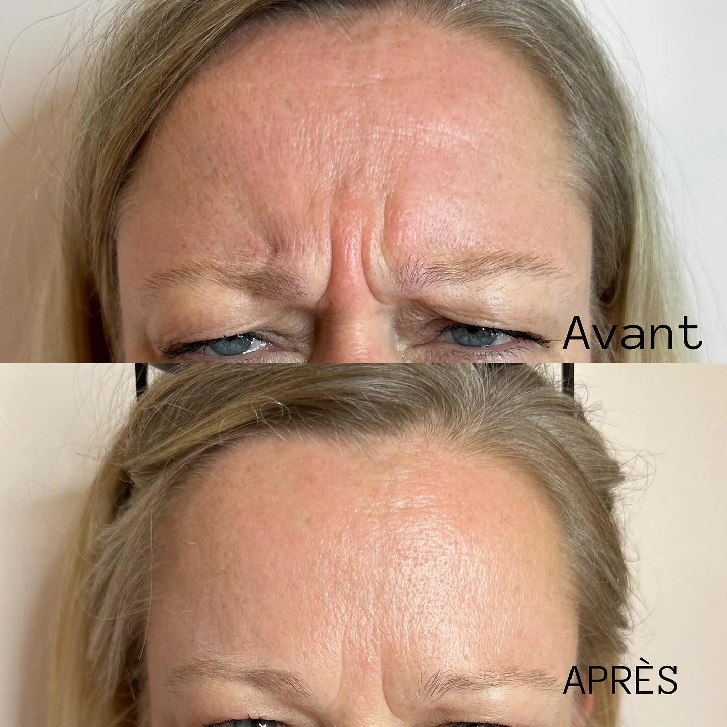 Avant et après un traitement des rides du front, montrant une réduction des rides et une peau plus lisse.