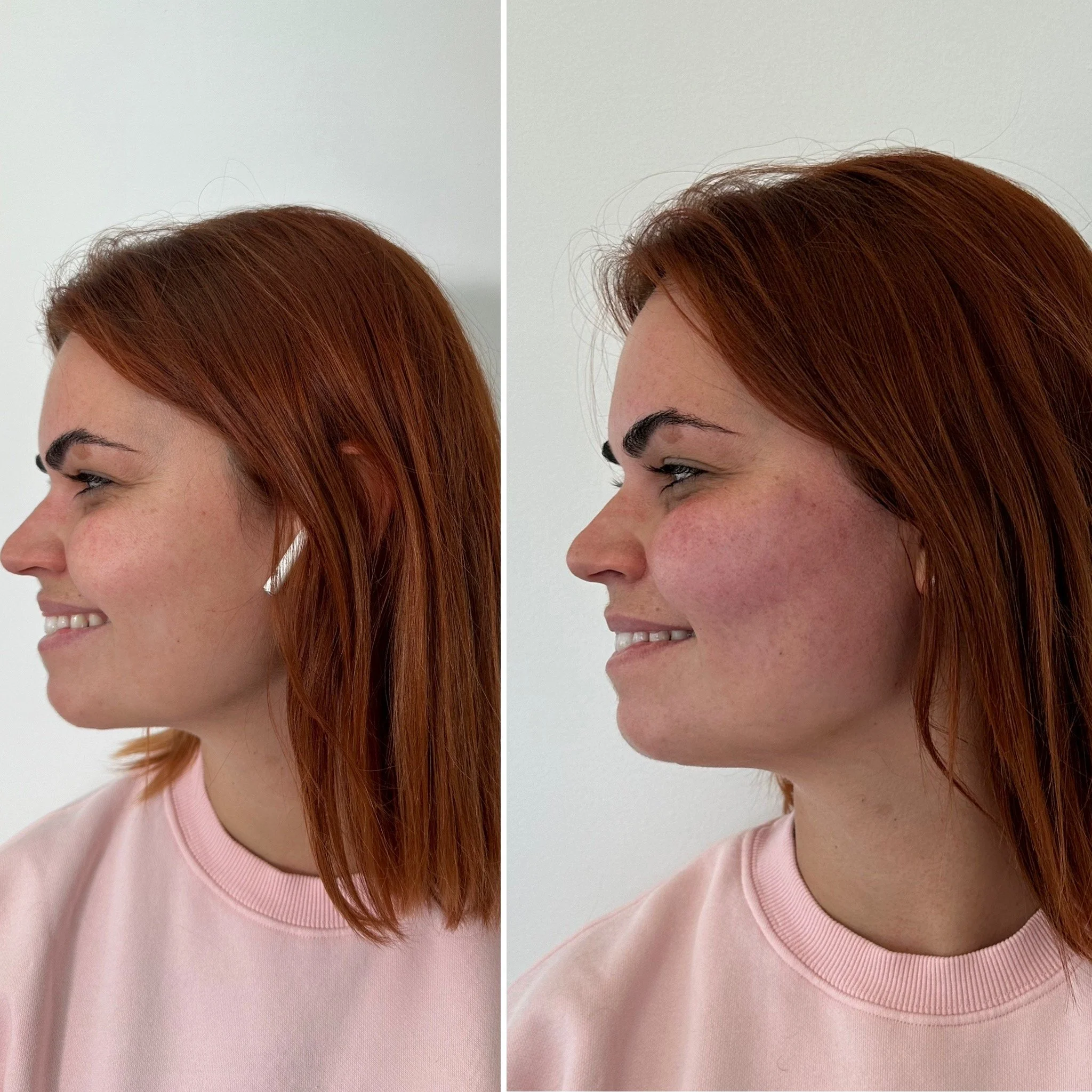 Deux images côte à côte d'une femme aux cheveux roux, souriant, vue de profil. La première image montre une peau claire et sans rougeur visible, tandis que la deuxième montre la même femme avec une peau rougie, surtout sur les joues.