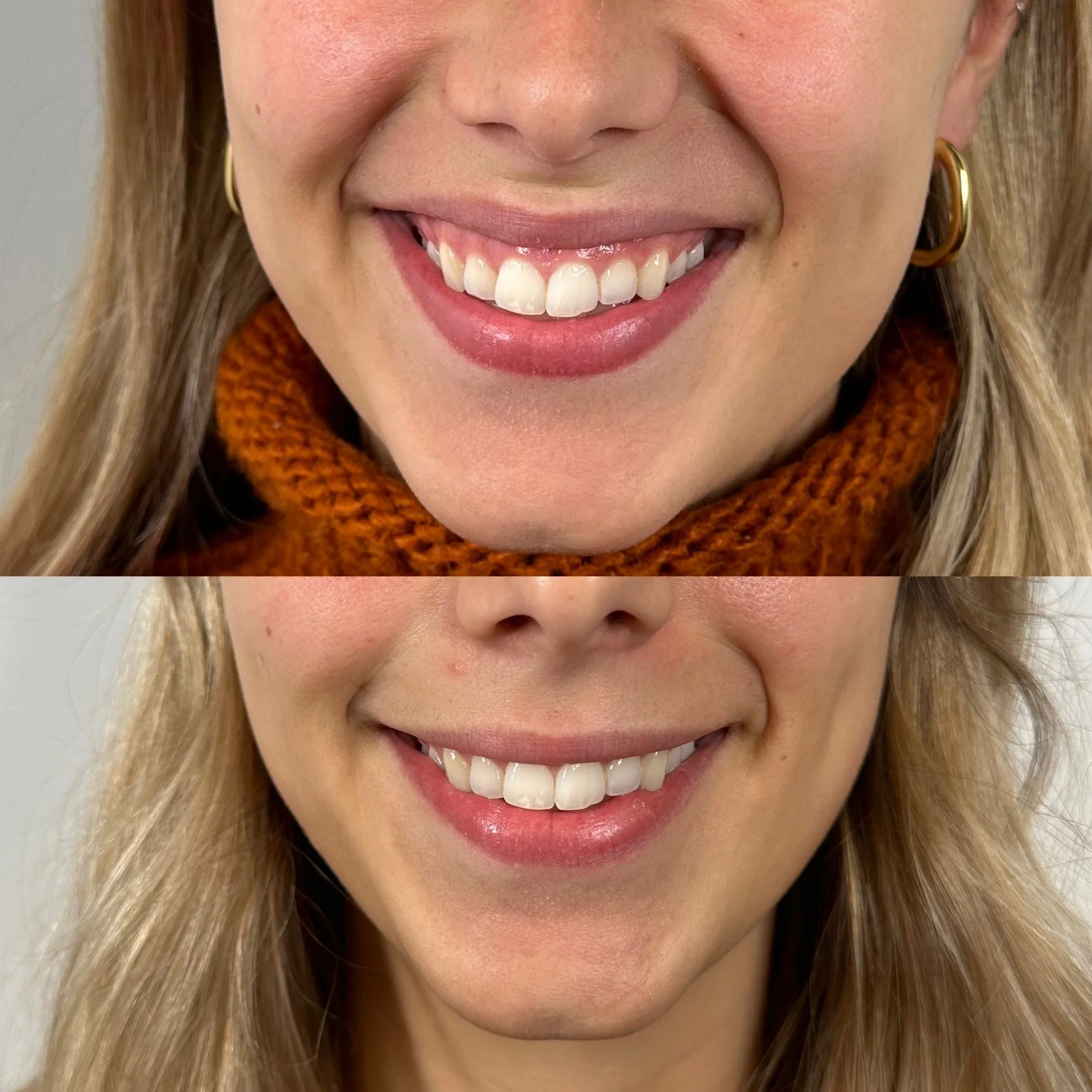 Deux photos rapprochées d'un sourire d'une femme, avant et après un blanchiment dentaire, mettant en valeur la différence de couleur des dents.