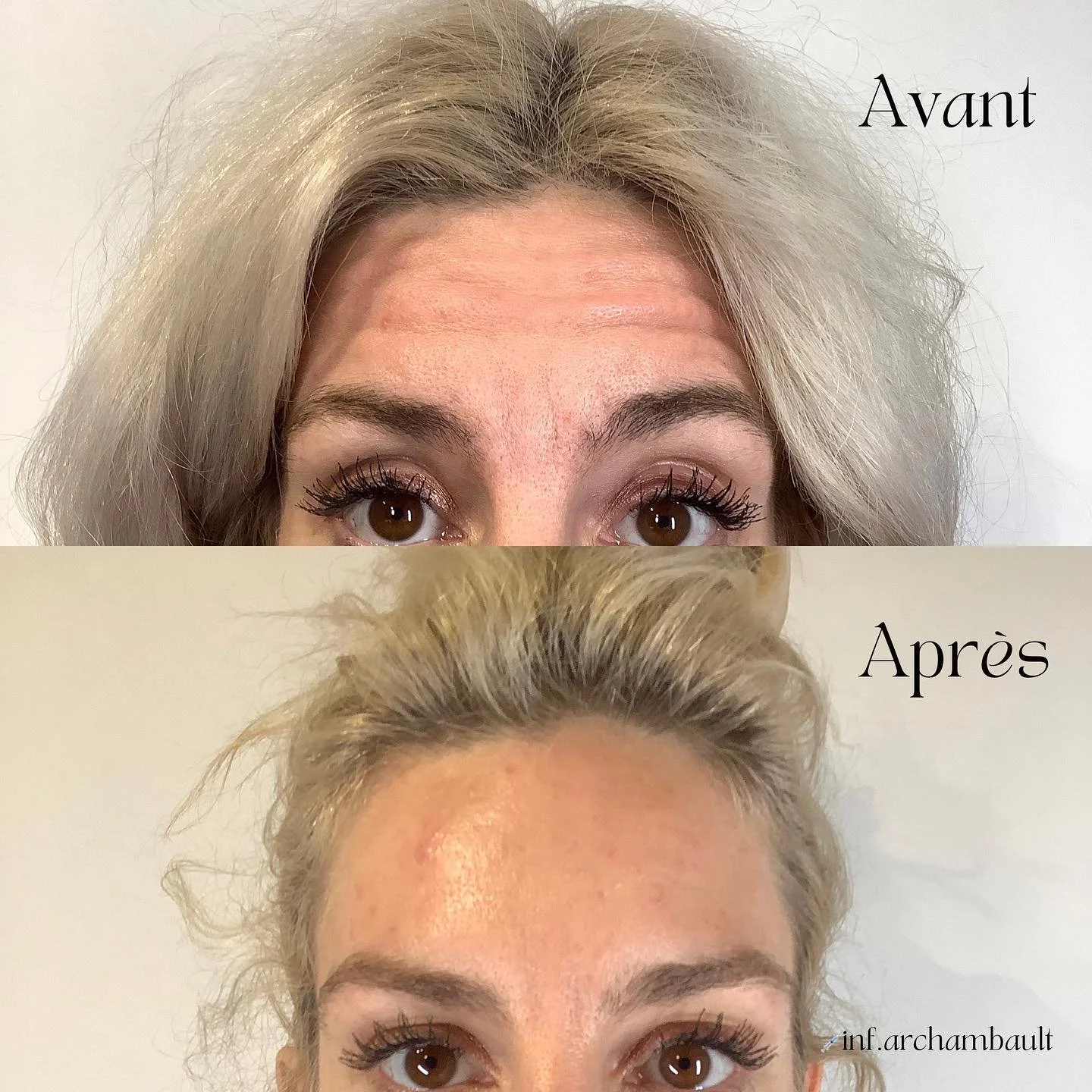 Comparaison avant et après d'un traitement esthétique, montrant le visage d'une femme avec des changements visibles sur la peau du front, les yeux et la chevelure.