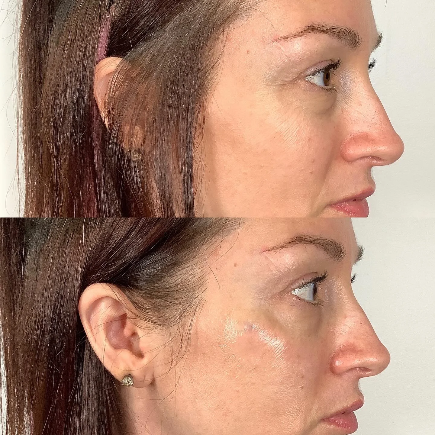 Comparaison avant et après traitement ou soins de la peau d'une femme, mettant en évidence une amélioration de la texture et de l'éclat de la peau.