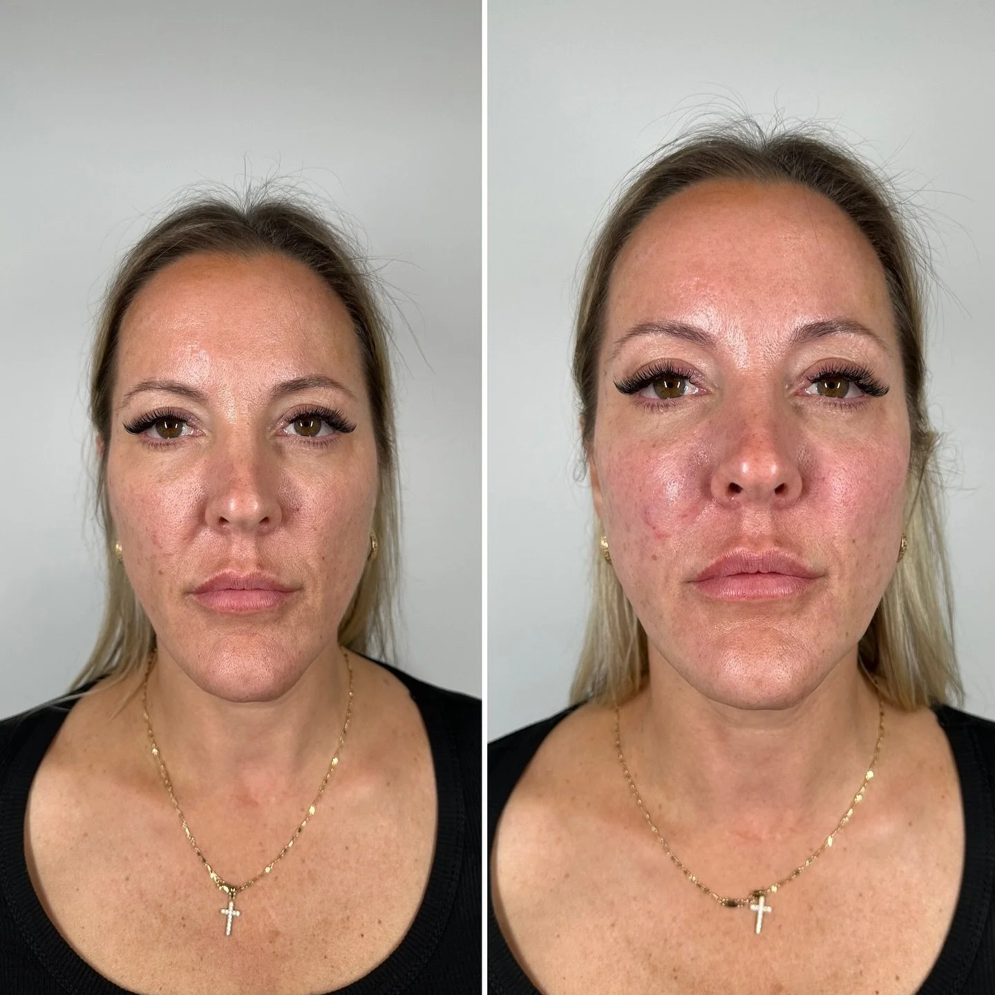 Comparison de deux photos d'une femme avant et après une intervention esthétique, montrant des différences dans la peau, notamment des rougeurs et des imperfections.