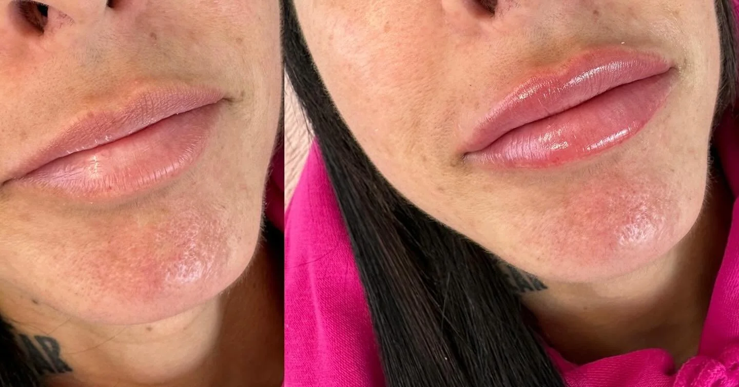 Zoom sur des lèvres pulpeuses et brillantes d'une femme avec une peau claire et quelques taches, portant un haut rose