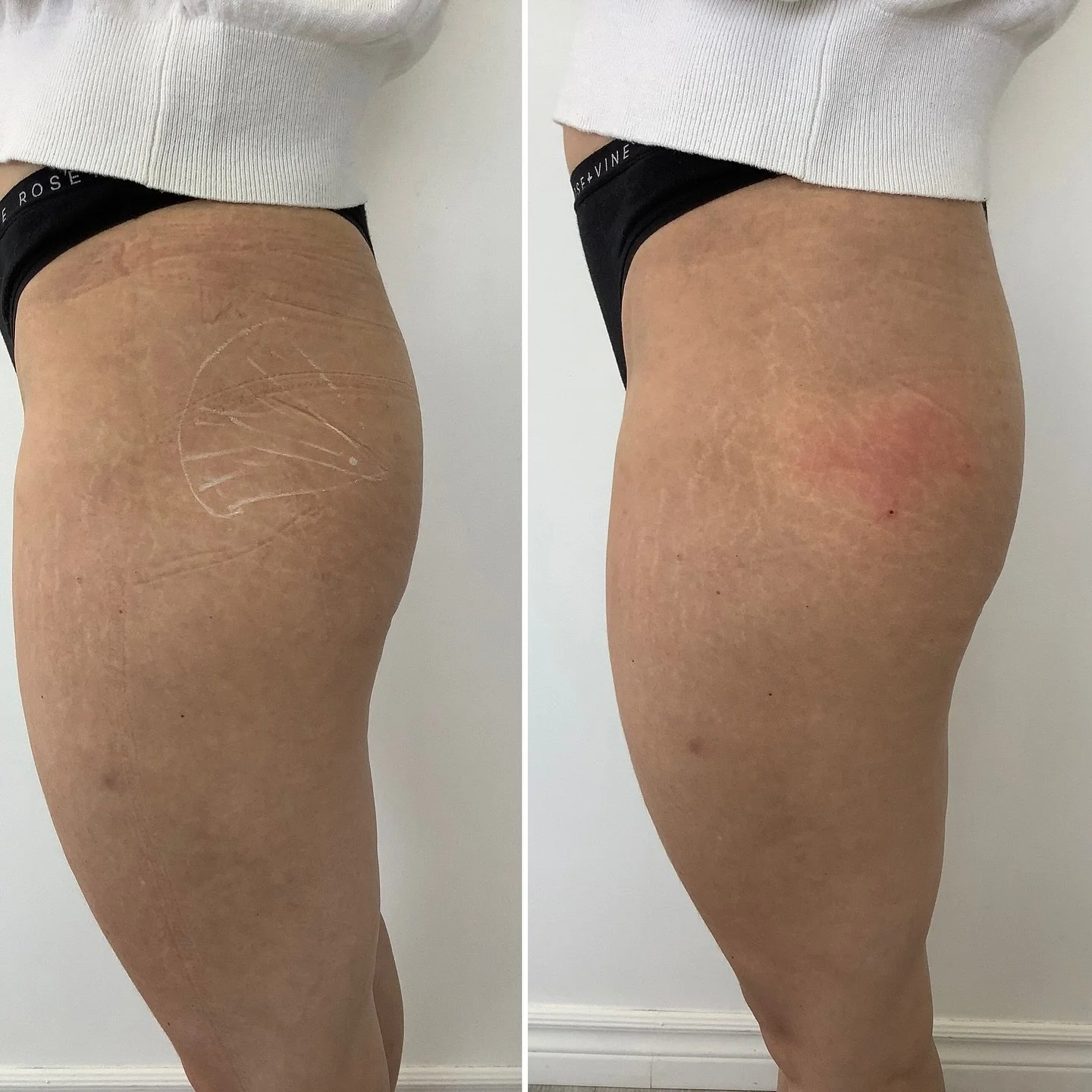 Photo comparative montrant la même cuisse avant (gauche) et après (droite) traitement contre la cellulite, avec une peau plus lisse et moins de marques visibles après le traitement.