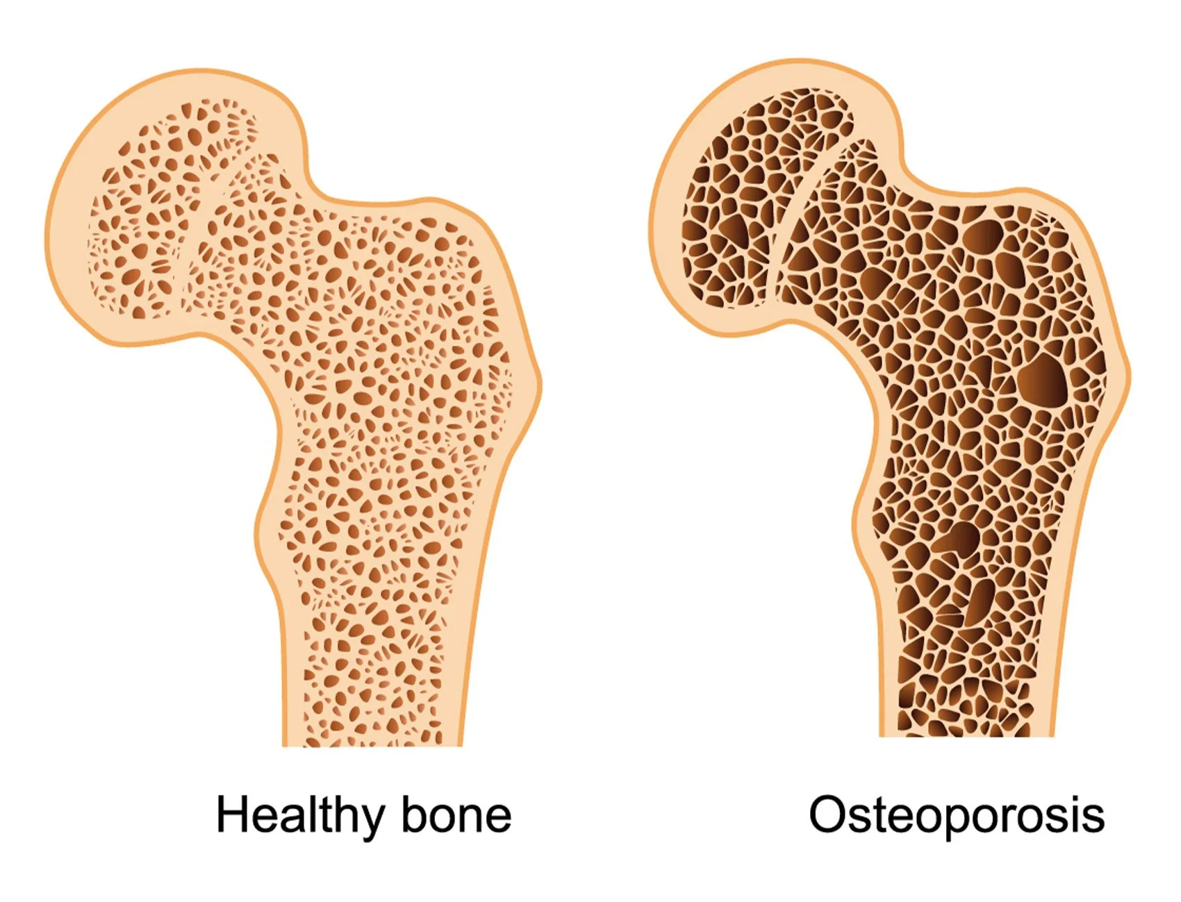 Osteoporosis: What It Is, Who’s at Risk, and How Movement Can Help
