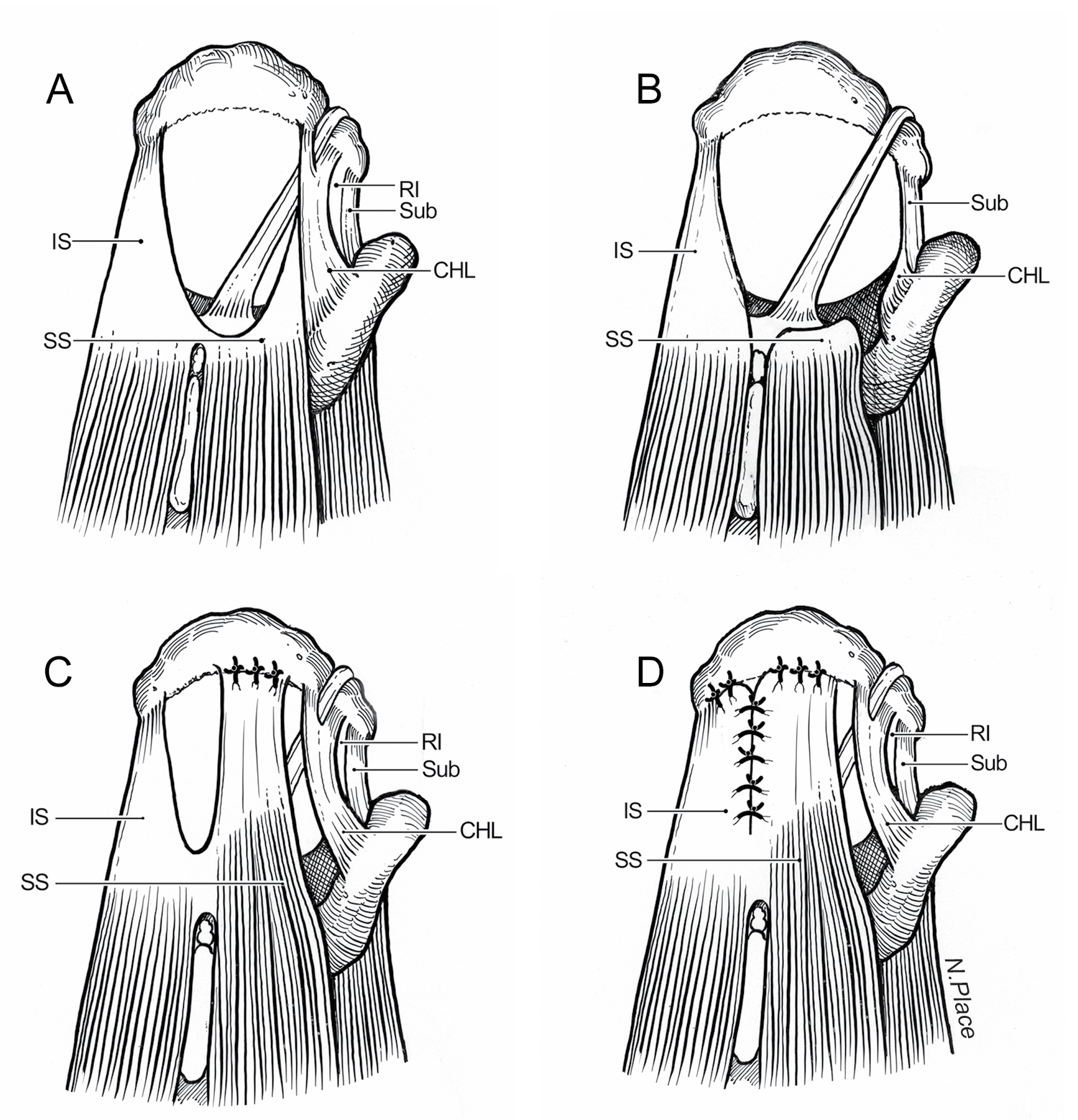 Rotator Cuff Tear Patterns.png