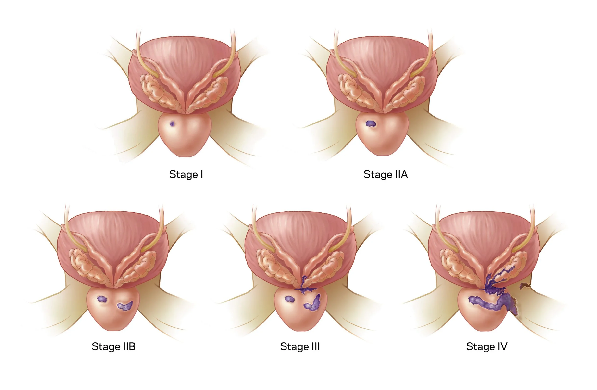 Prostrate Cancer Stages.jpg