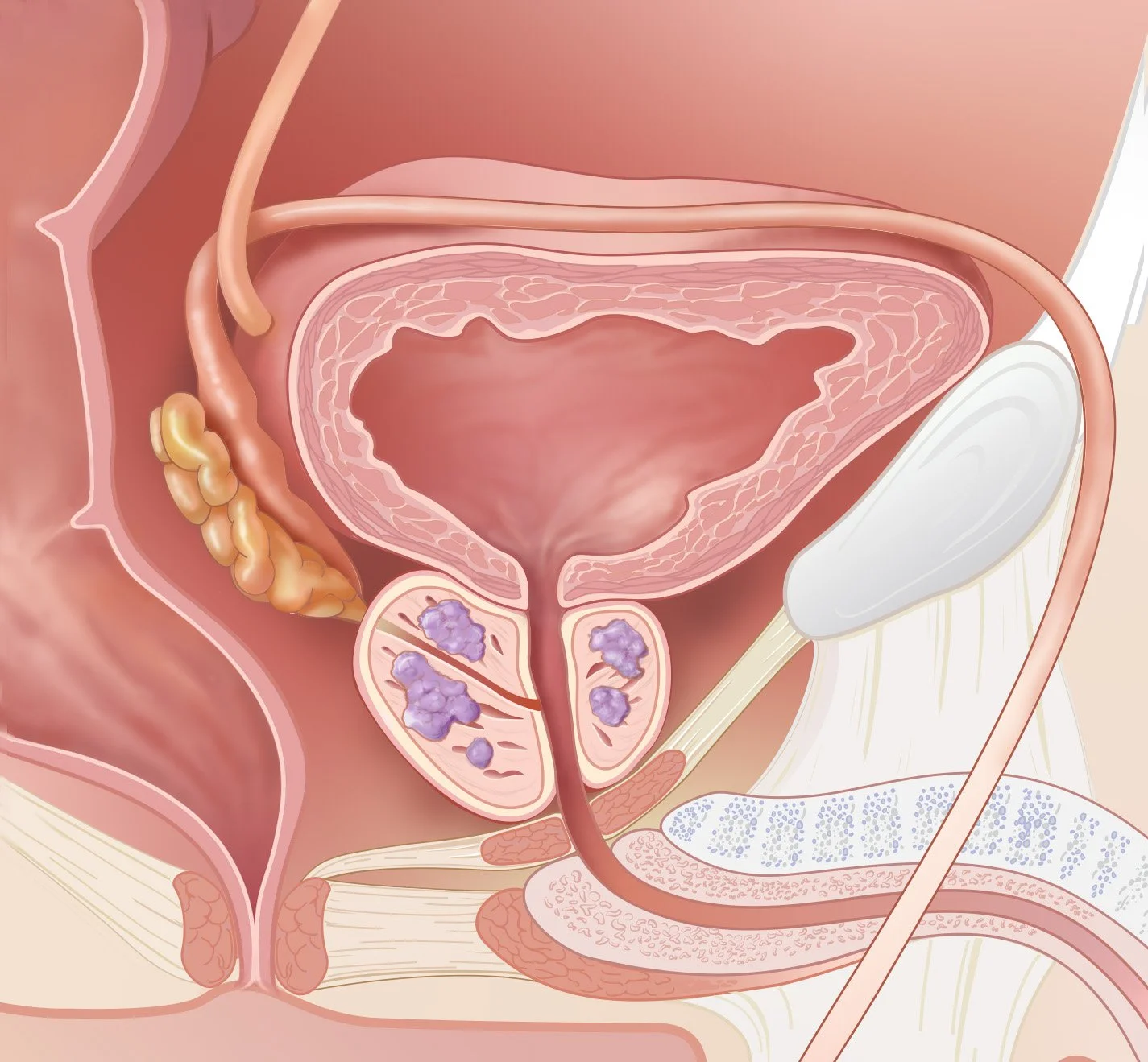 Simple Tumor Cropped PPT.jpg