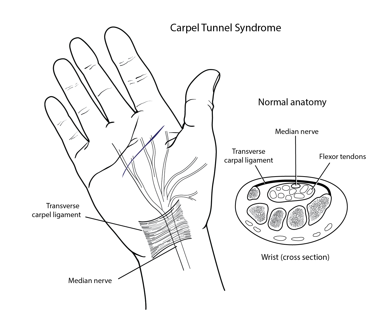 Patient Education Series_carpel tunnel.png