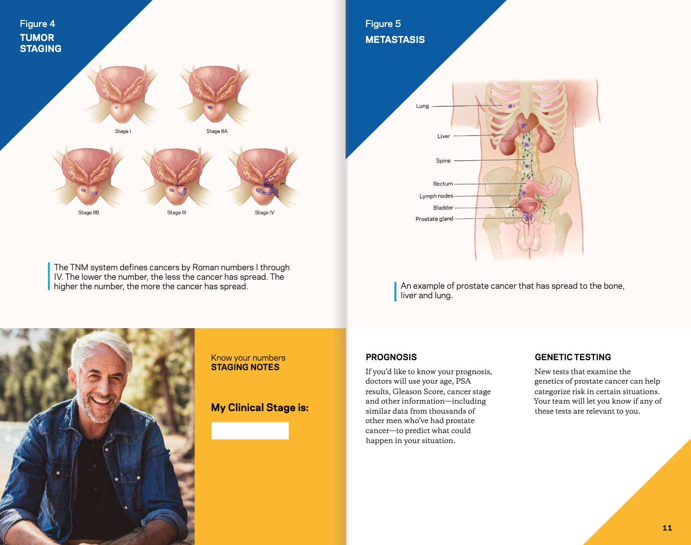 Prostate cancer and treatments