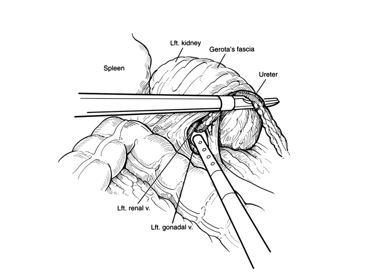 Surgery of the kidney.png