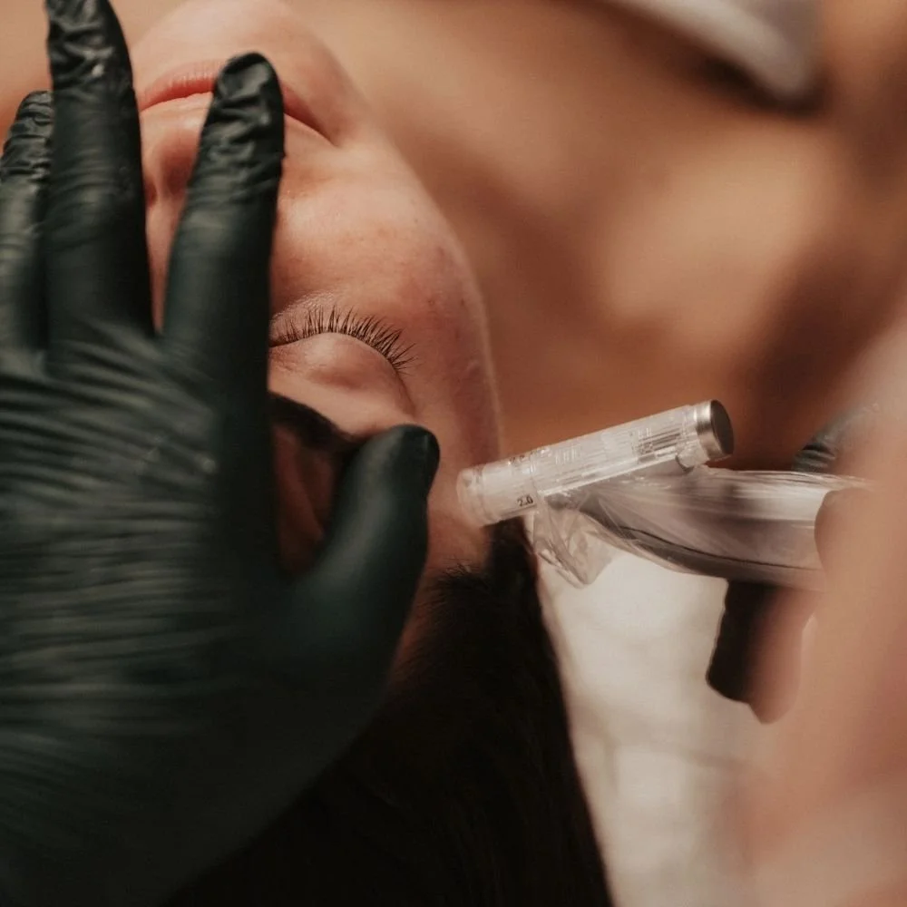 Female client receives microneedling treatment at Preparations