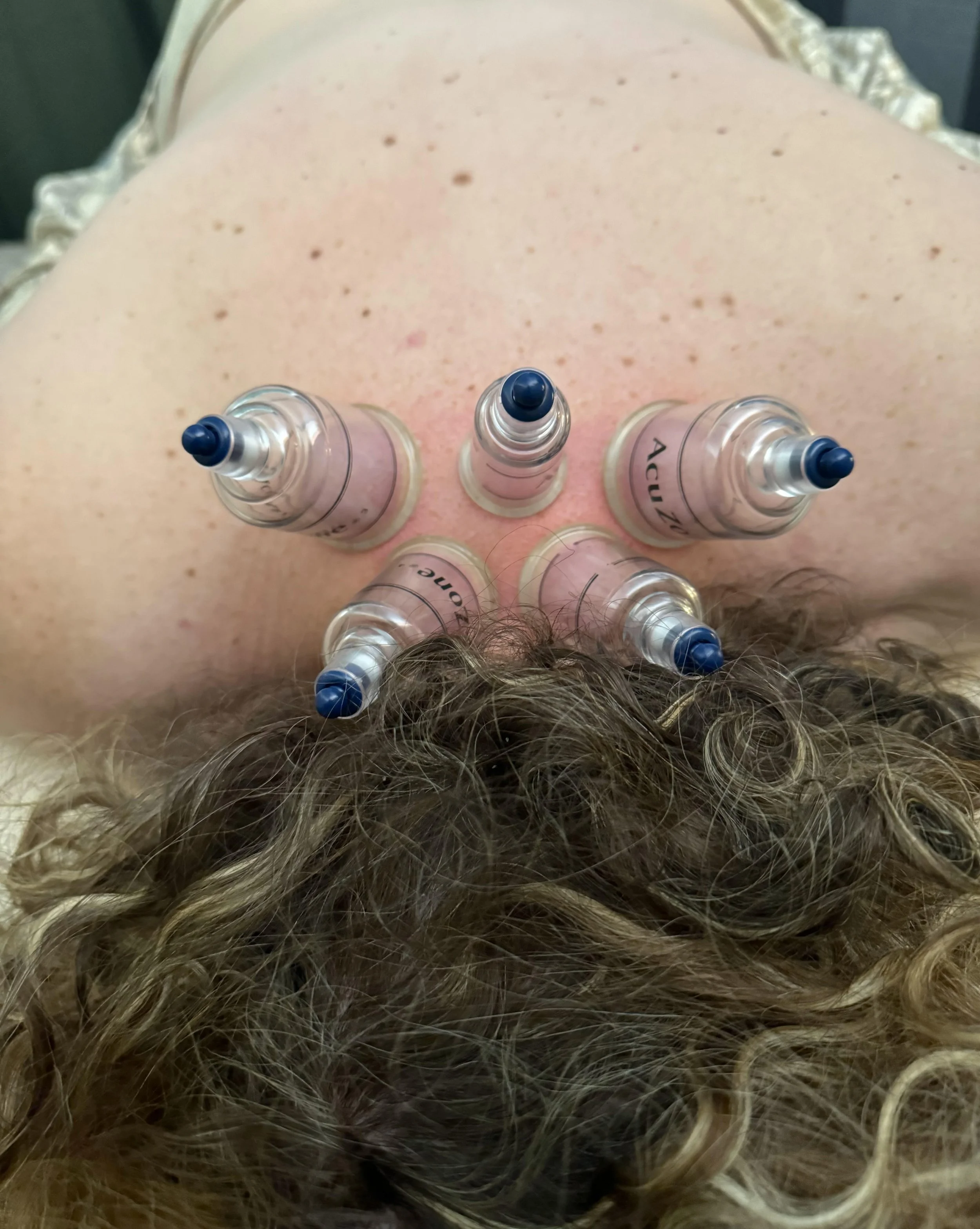 Person with curly hair lying down with five cupping cups on their back.