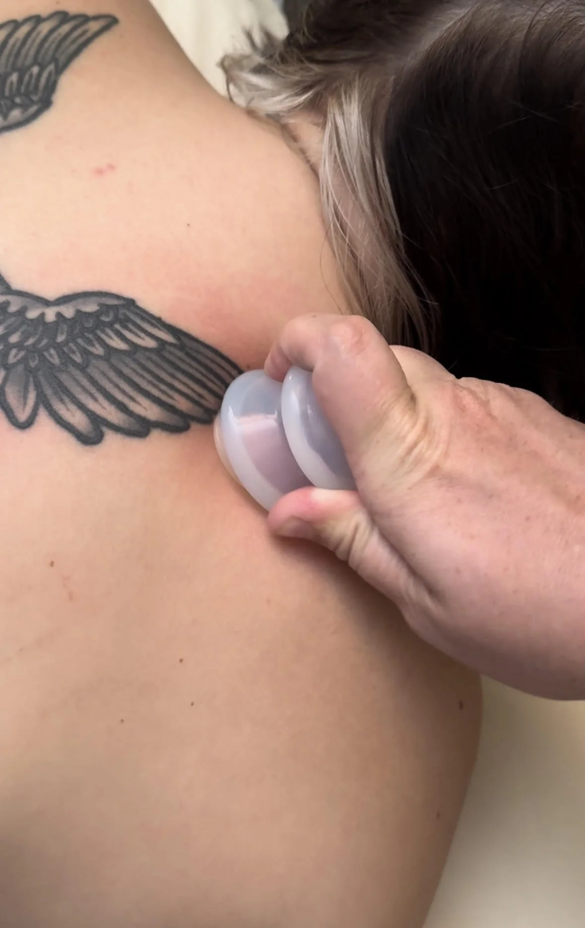 A person receiving cupping treatment on their upper shoulder.