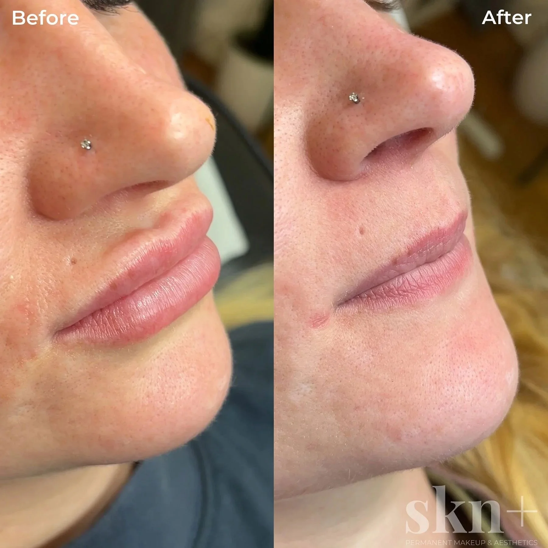 lip-filler-dissolving-1-skn-plus-in-stone-near-stafford-and-stoke-on-trent-staffordshire.jpg
