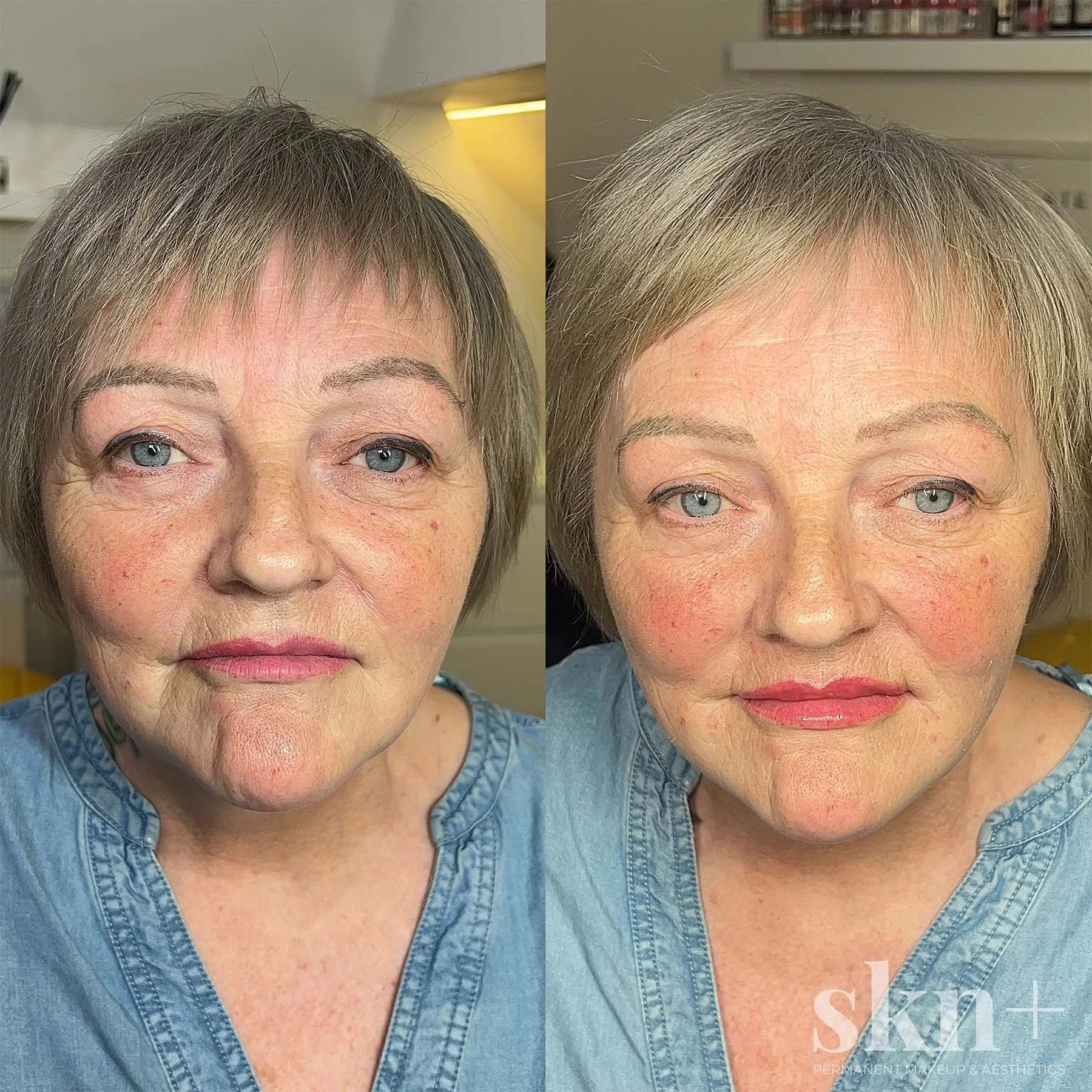 dermal-filler-1-skn-plus-in-stone-near-stafford-and-stoke-on-trent-staffordshire.jpg