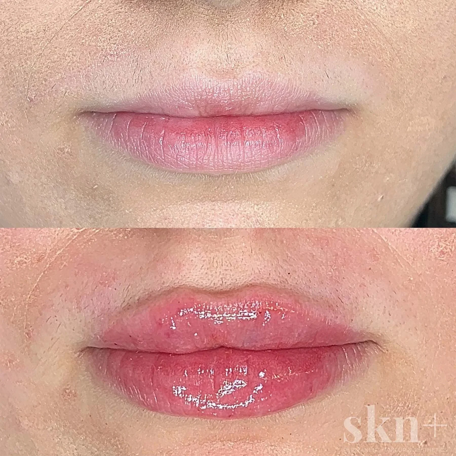 lip-filler-2-skn-plus-in-stone-near-stafford-and-stoke-on-trent-staffordshire.jpg