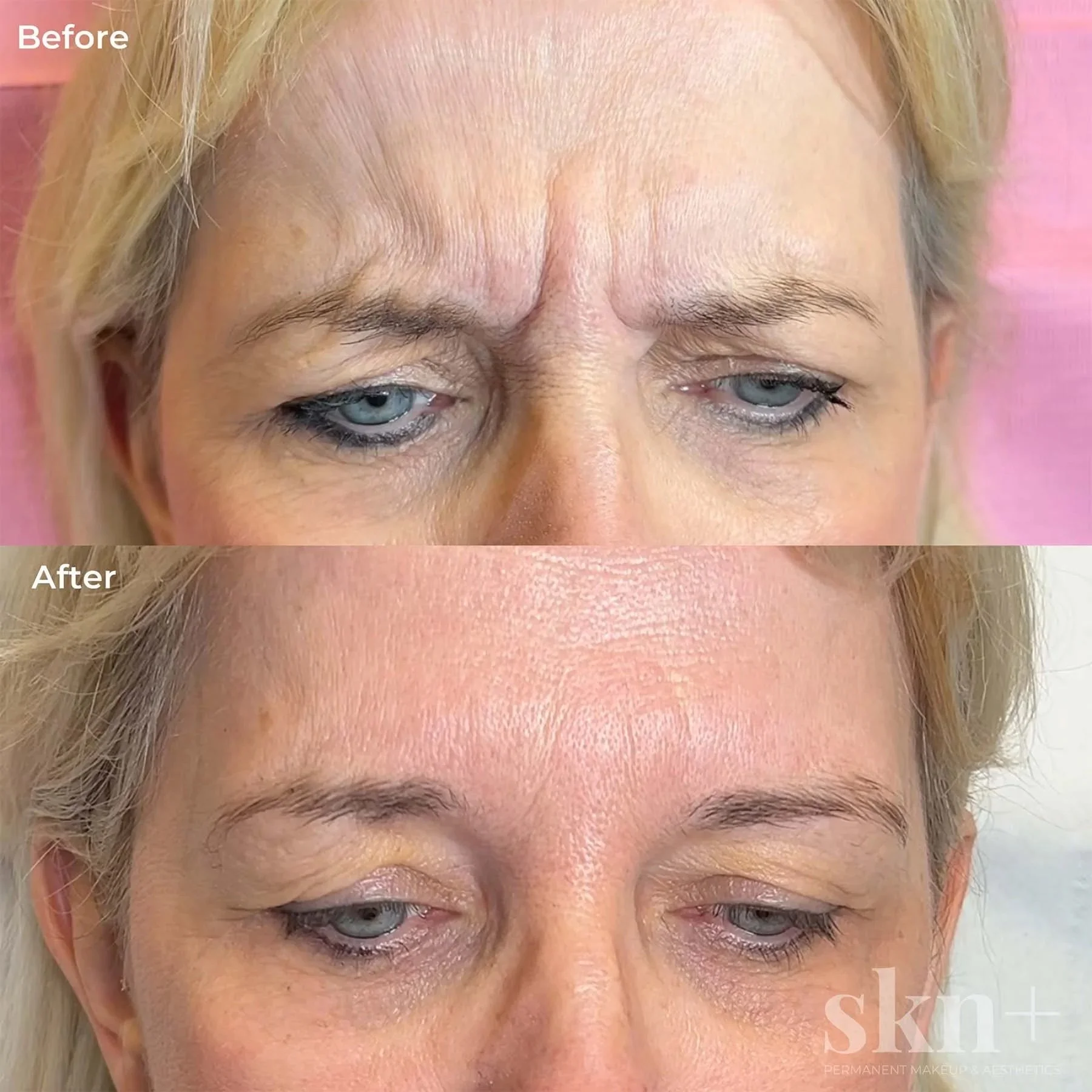 anti-wrinkle-injections-1-skn-plus-in-stone-near-stafford-and-stoke-on-trent-staffordshire.jpg