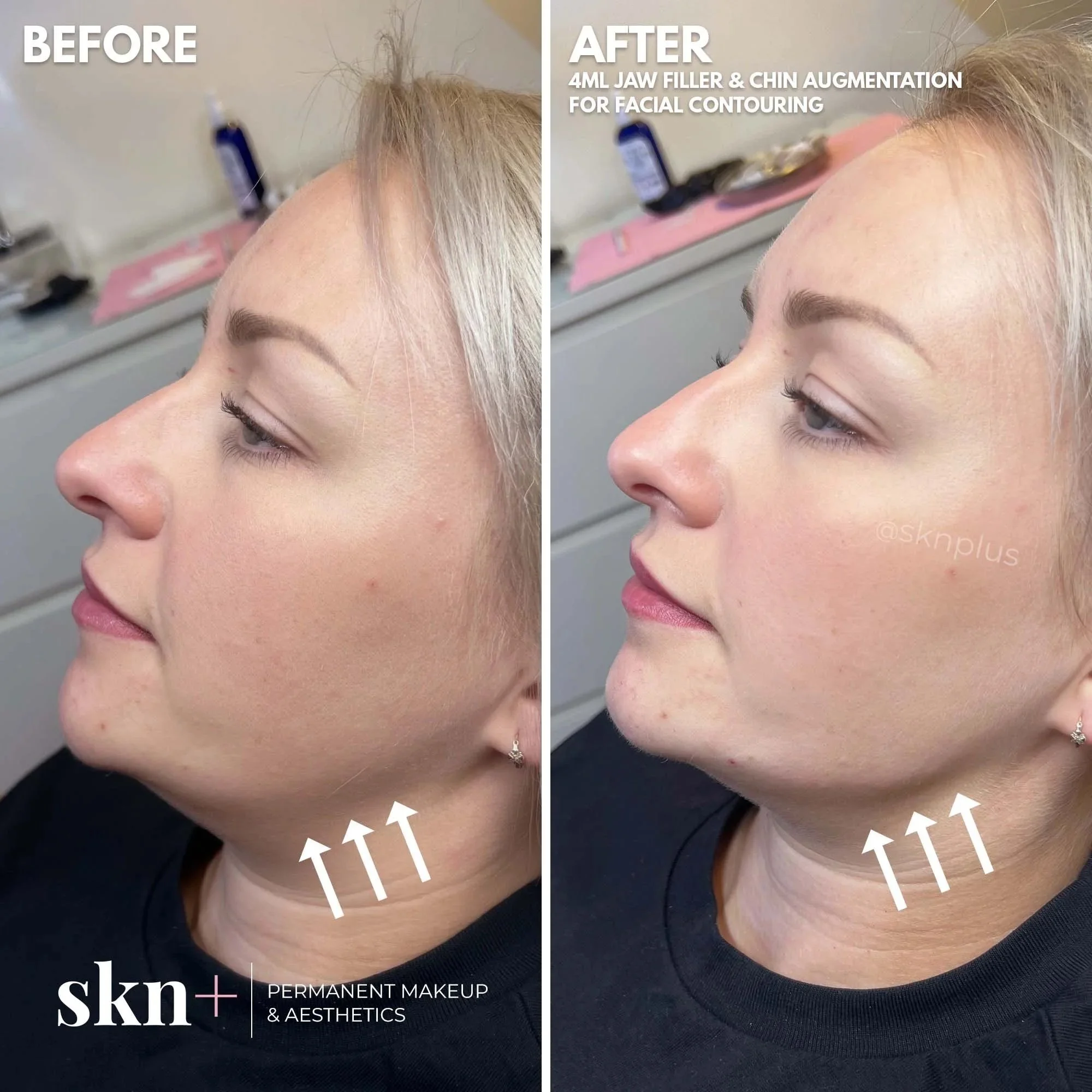 dermal-filler-skn-plus-in-stone-by-stafford-and-stoke-on-trent-staffordshire.jpg