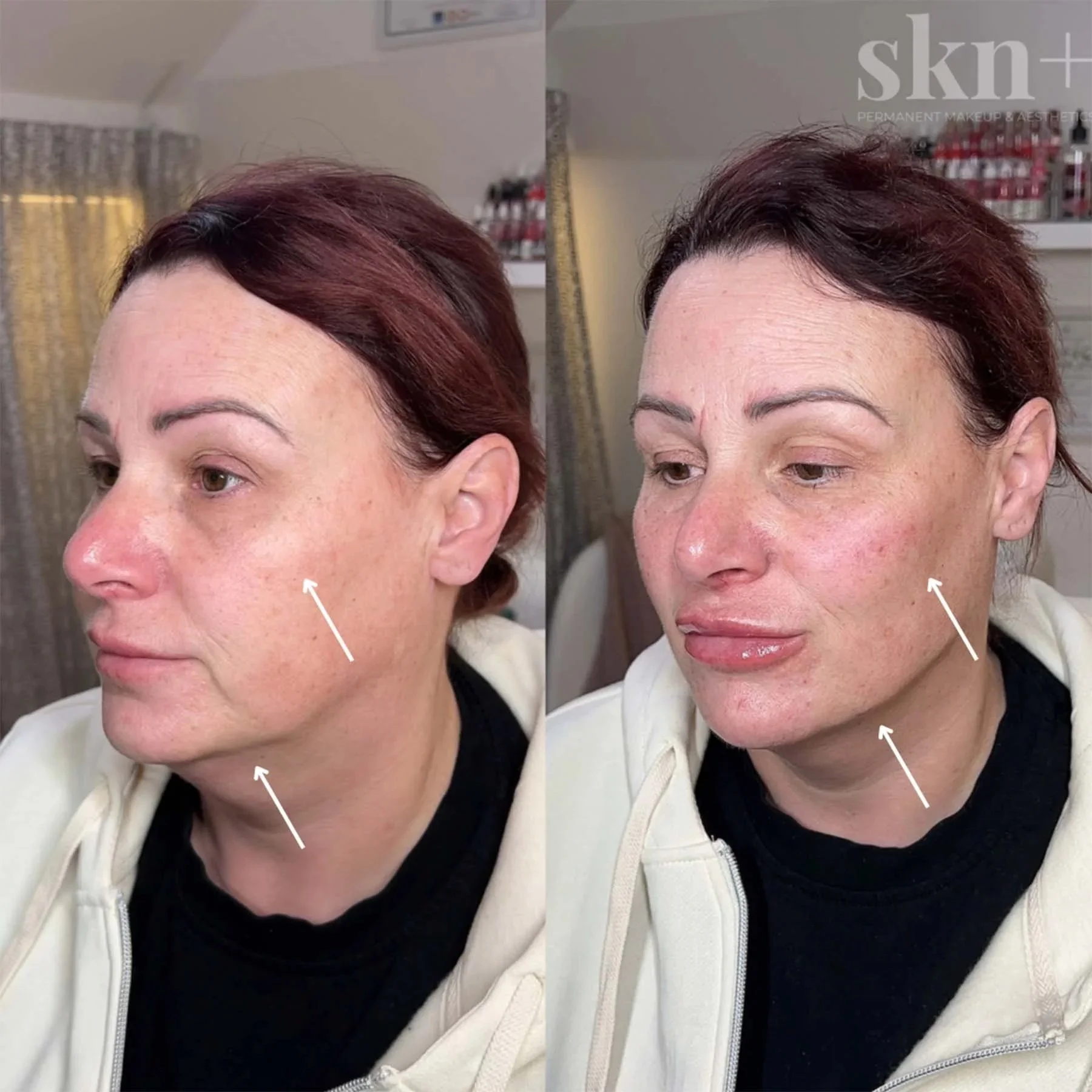 dermal-filler-2-skn-plus-in-stone-near-stafford-and-stoke-on-trent-staffordshire.jpg