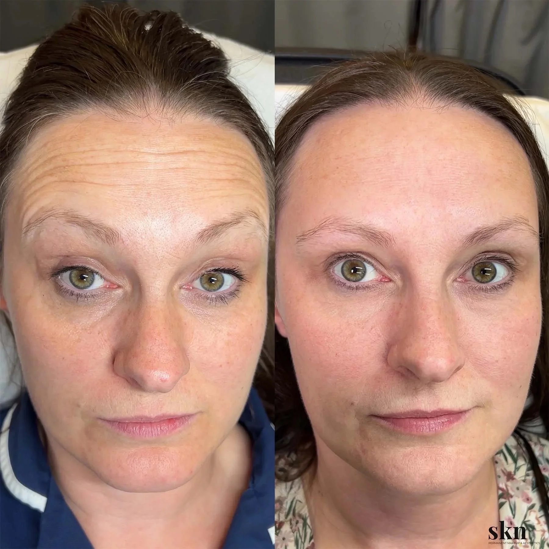 anti-wrinkle-injections-4-skn-plus-in-stone-near-stafford-and-stoke-on-trent-staffordshire.jpg