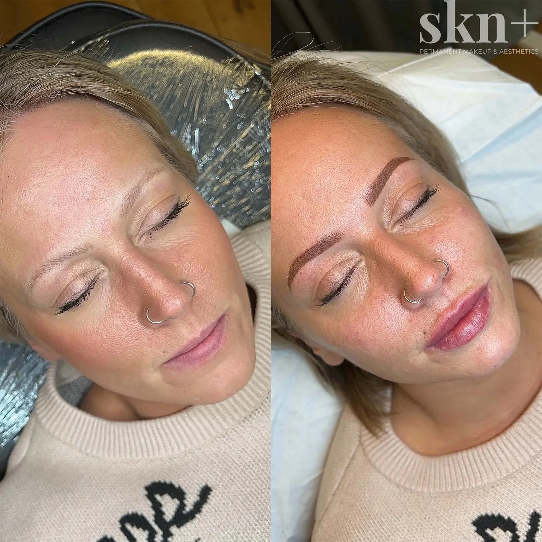 dermal-filler-3-skn-plus-in-stone-near-stafford-and-stoke-on-trent-staffordshire.jpg