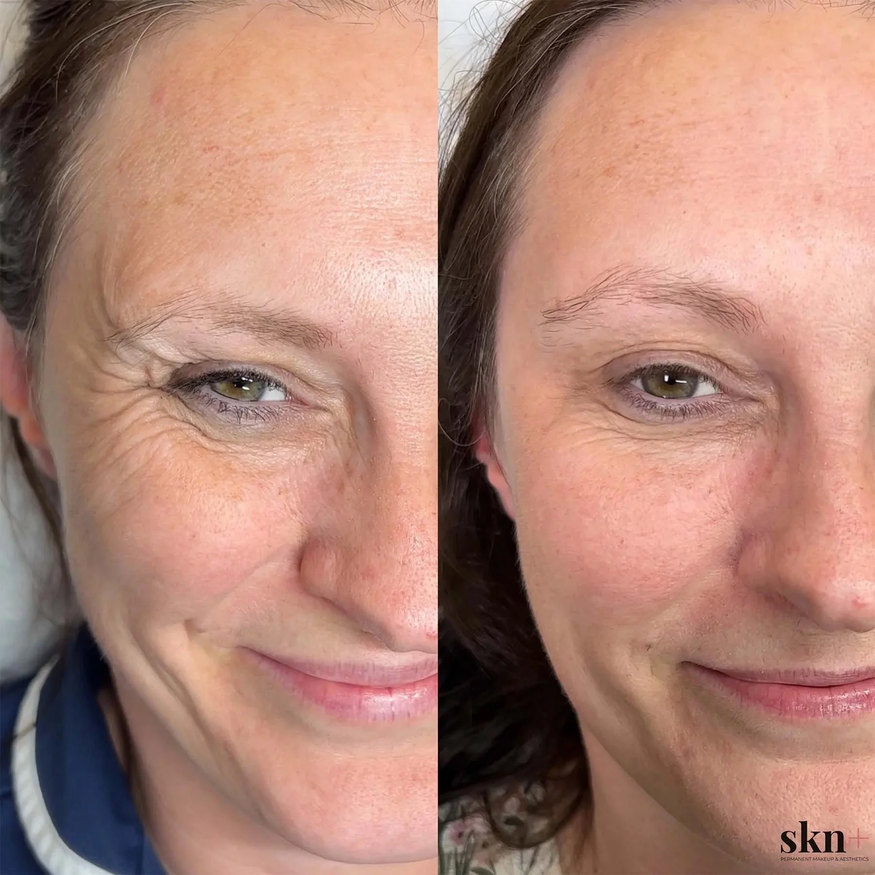 anti-wrinkle-injections-3-skn-plus-in-stone-near-stafford-and-stoke-on-trent-staffordshire.jpg