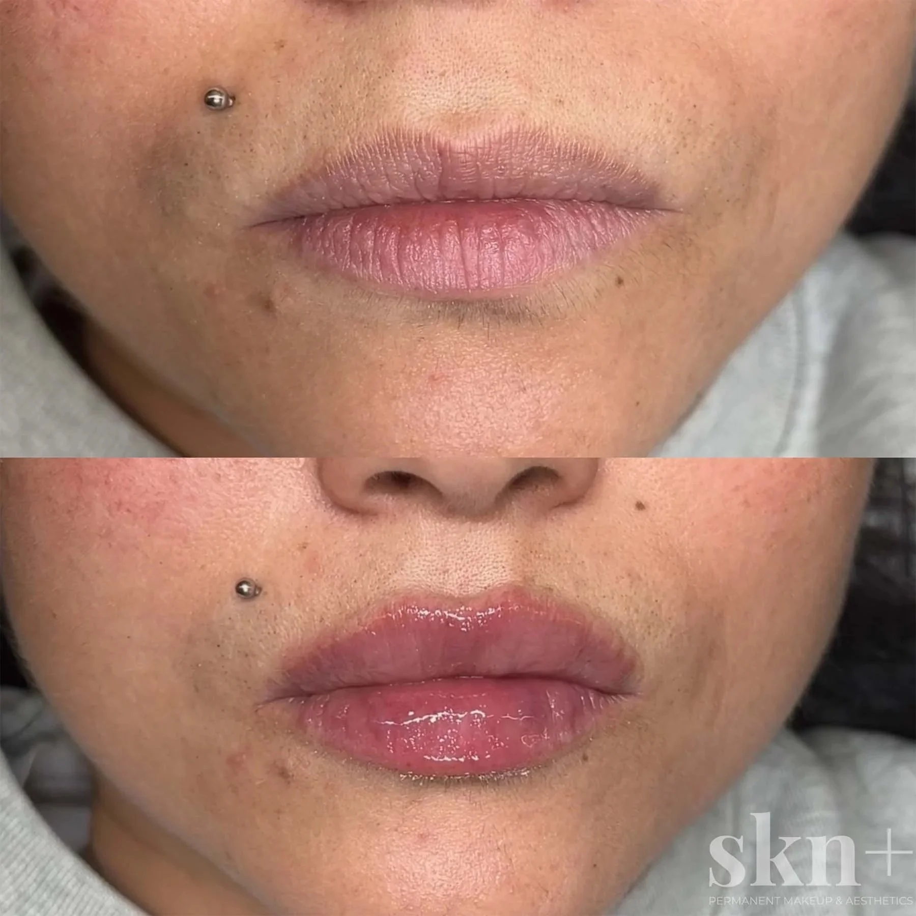 lip-filler-1-skn-plus-in-stone-near-stafford-and-stoke-on-trent-staffordshire.jpg