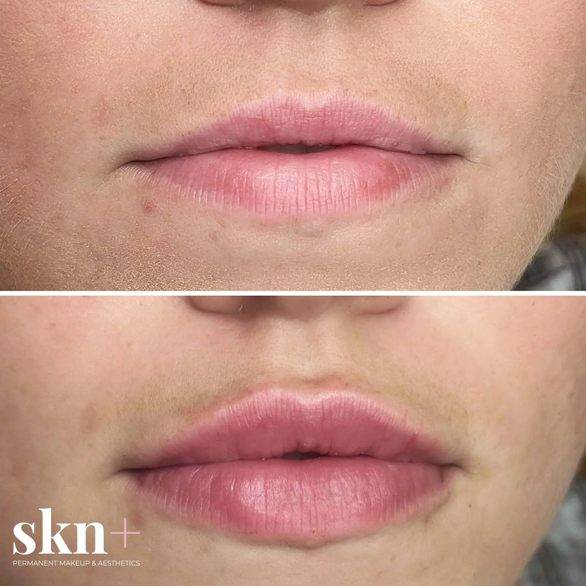 lip-fillers-skn-plus-in-stone-by-stafford-and-stoke-staffordshire1.jpg