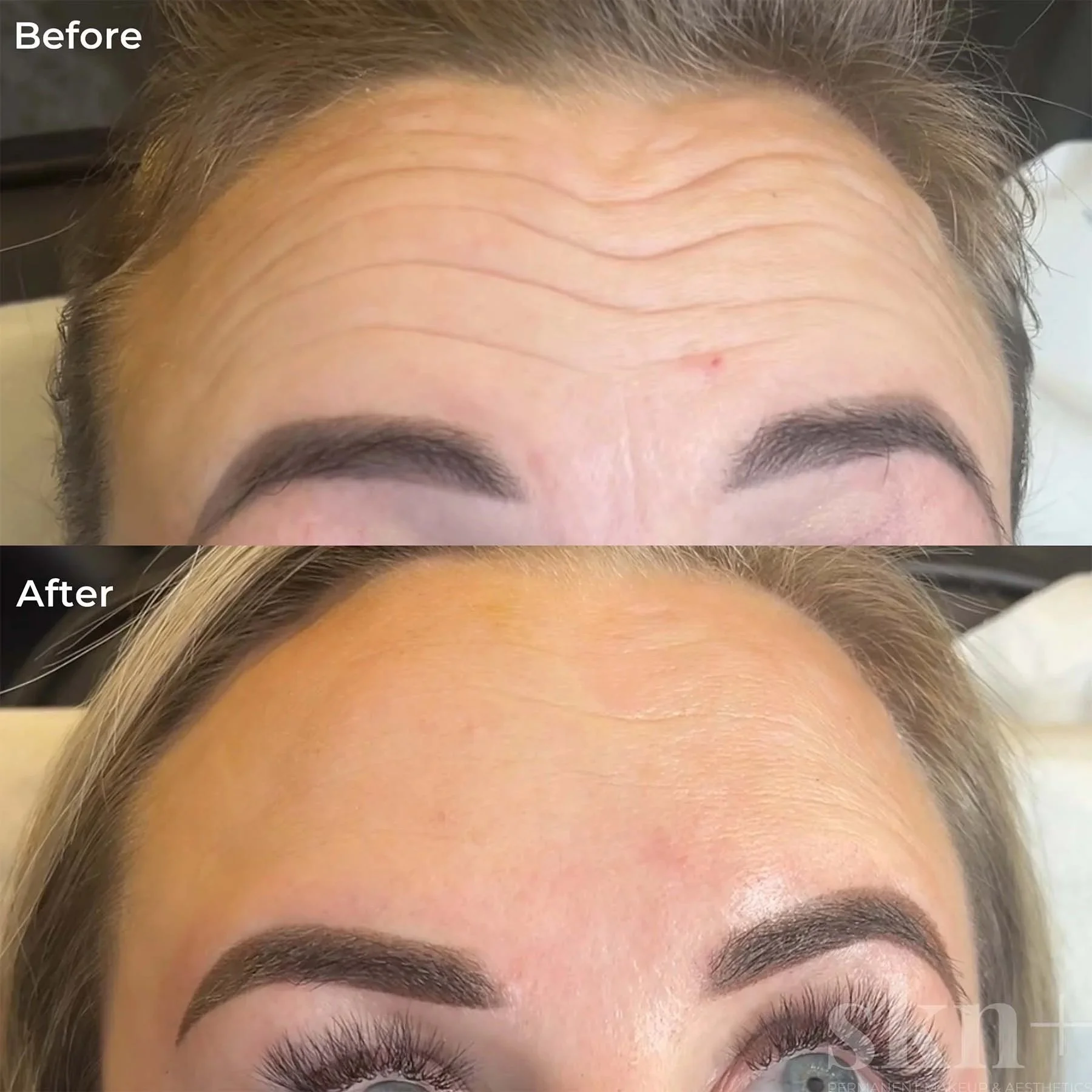 anti-wrinkle-injections-5-skn-plus-in-stone-near-stafford-and-stoke-on-trent-staffordshire.jpg