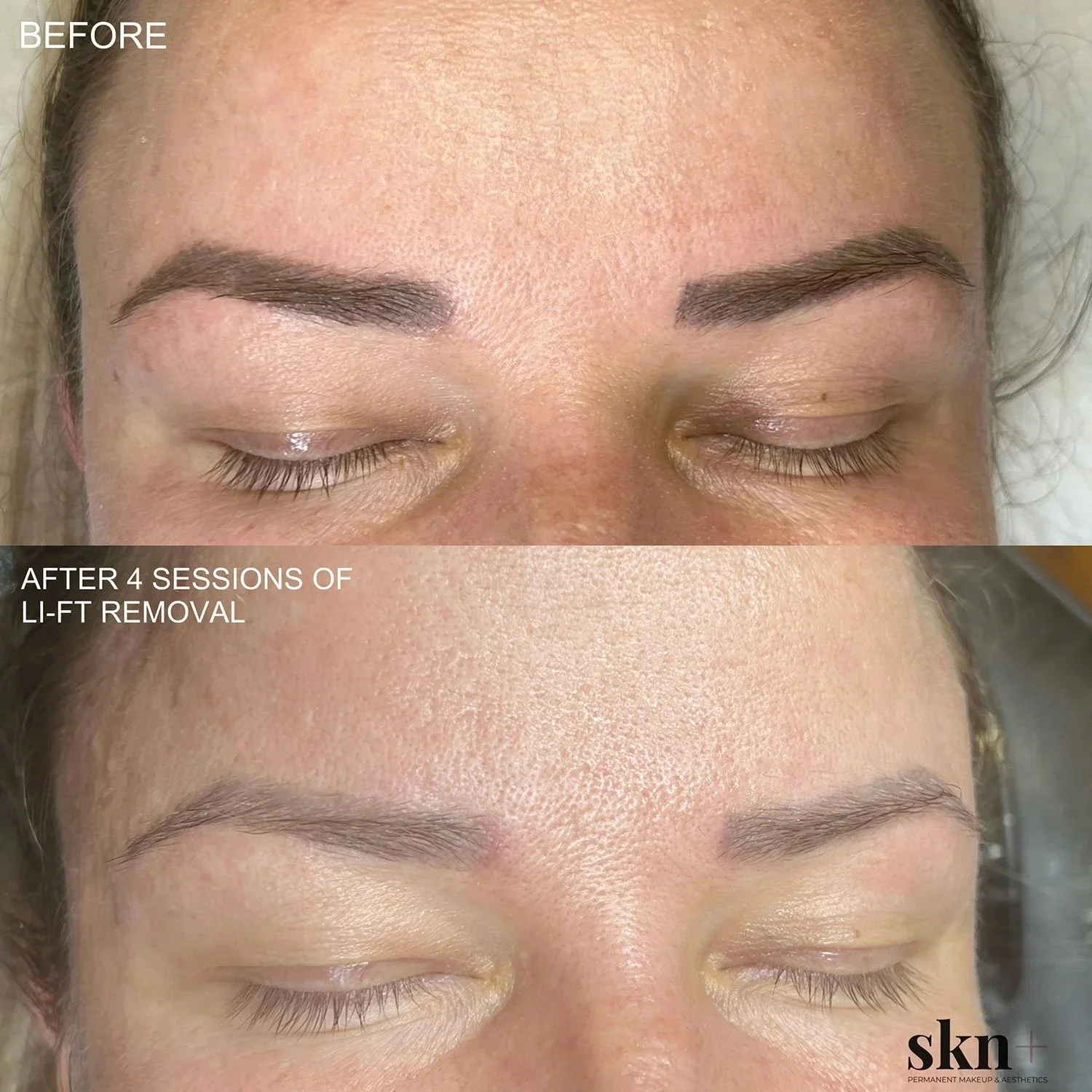 Woman after microblading removal in Staffordshire