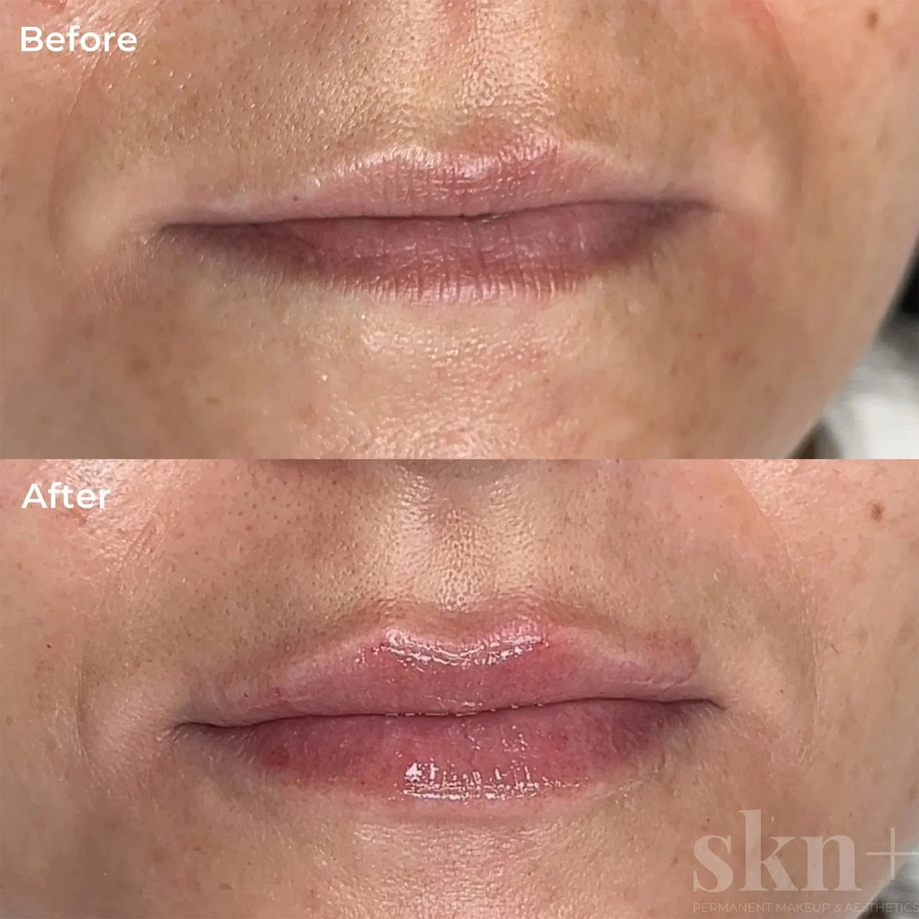 lip-filler-5-skn-plus-in-stone-near-stafford-and-stoke-on-trent-staffordshire.jpg