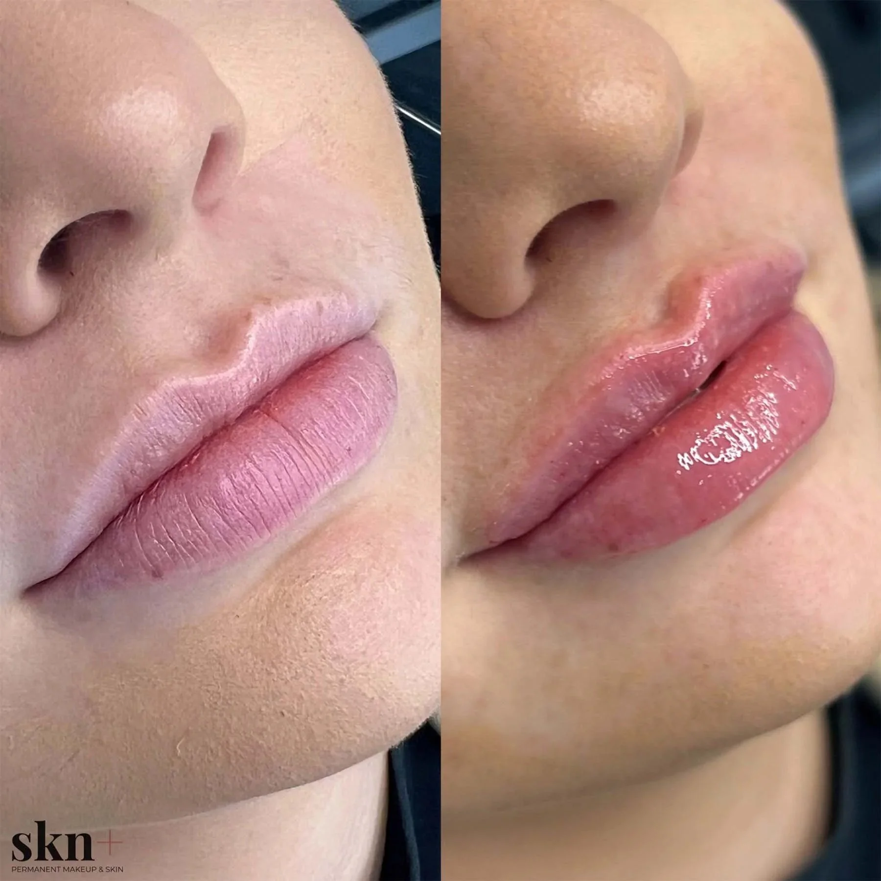 lip-filler-6-skn-plus-in-stone-near-stafford-and-stoke-on-trent-staffordshire.jpg