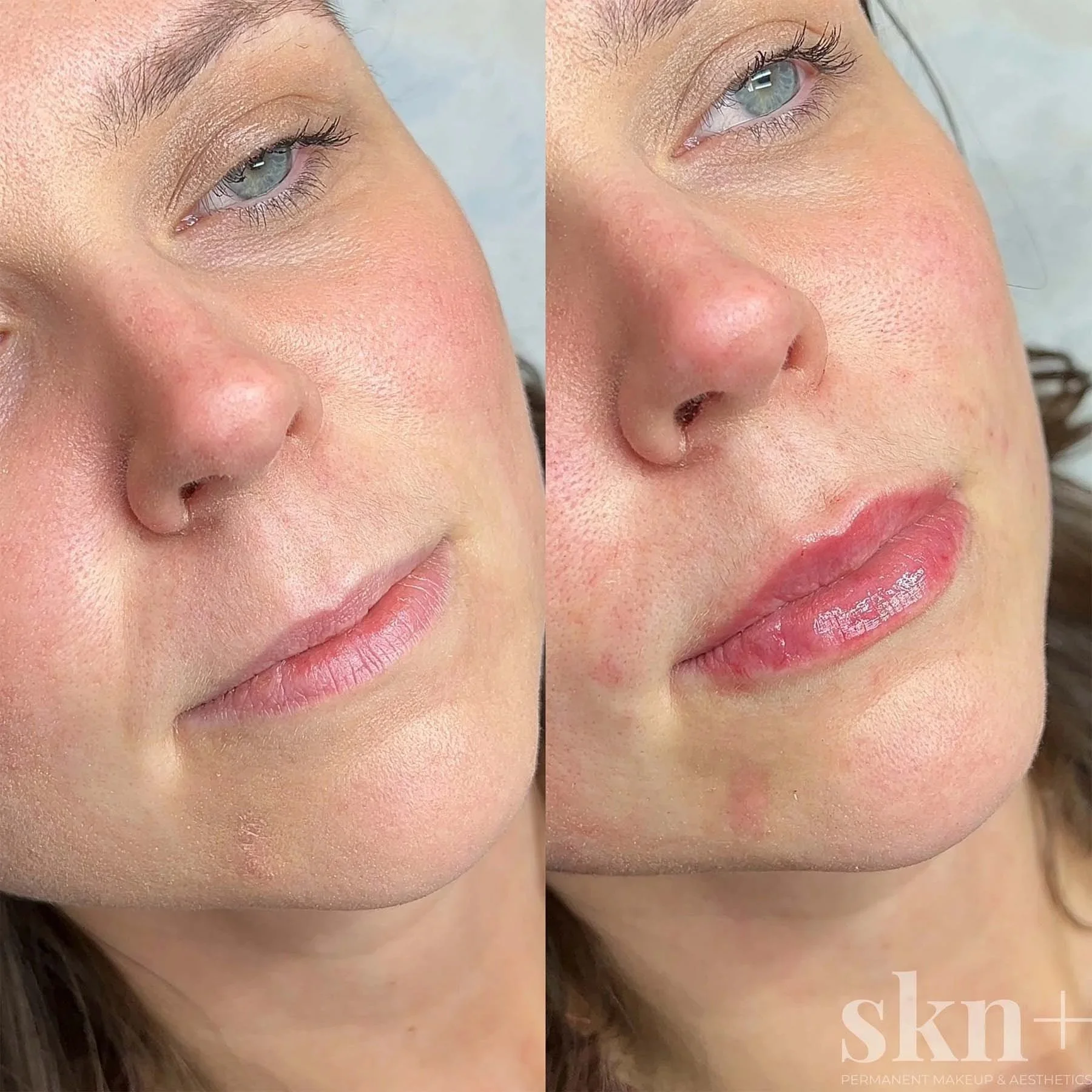 lip-filler-4-skn-plus-in-stone-near-stafford-and-stoke-on-trent-staffordshire.jpg