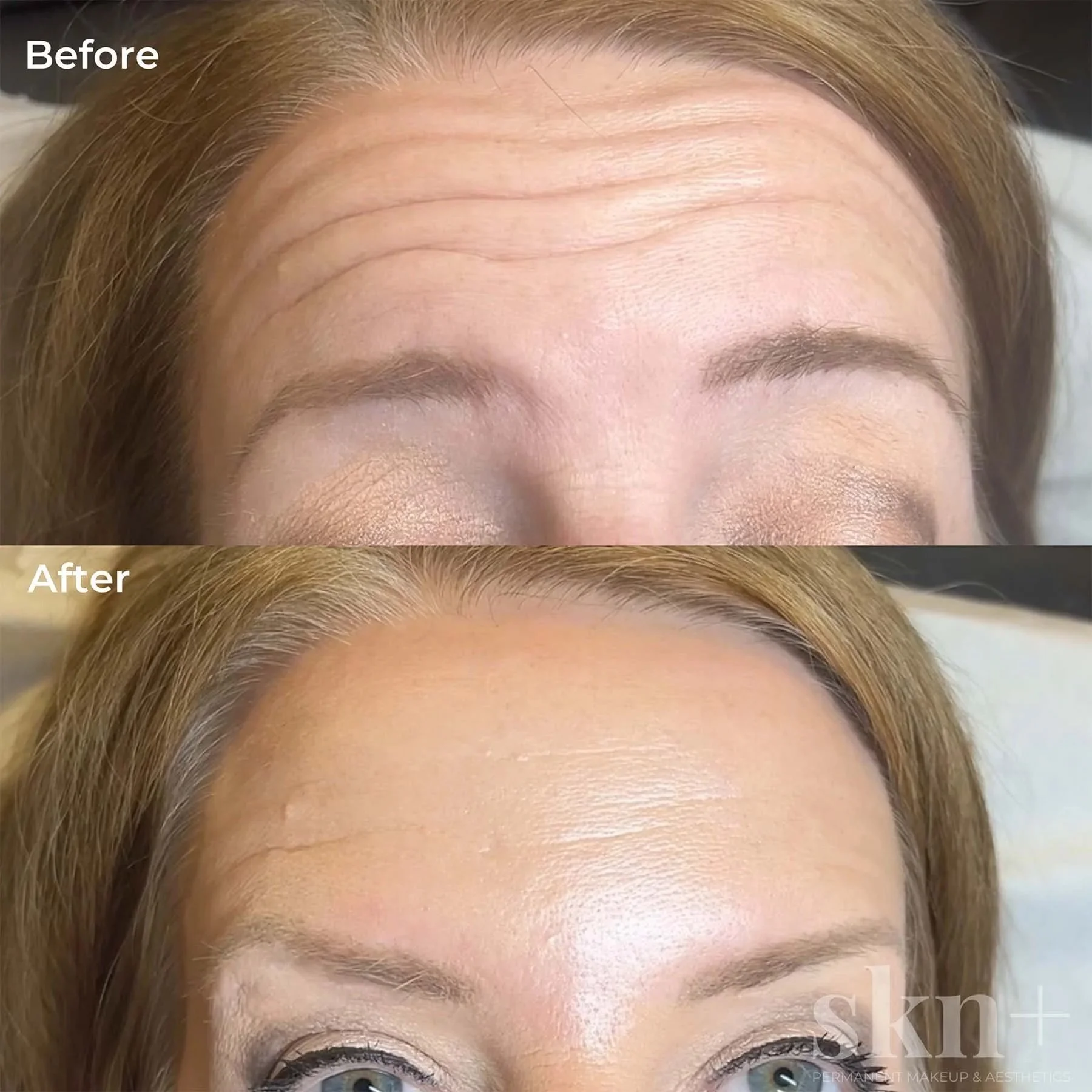 anti-wrinkle-injections-2-skn-plus-in-stone-near-stafford-and-stoke-on-trent-staffordshire.jpg