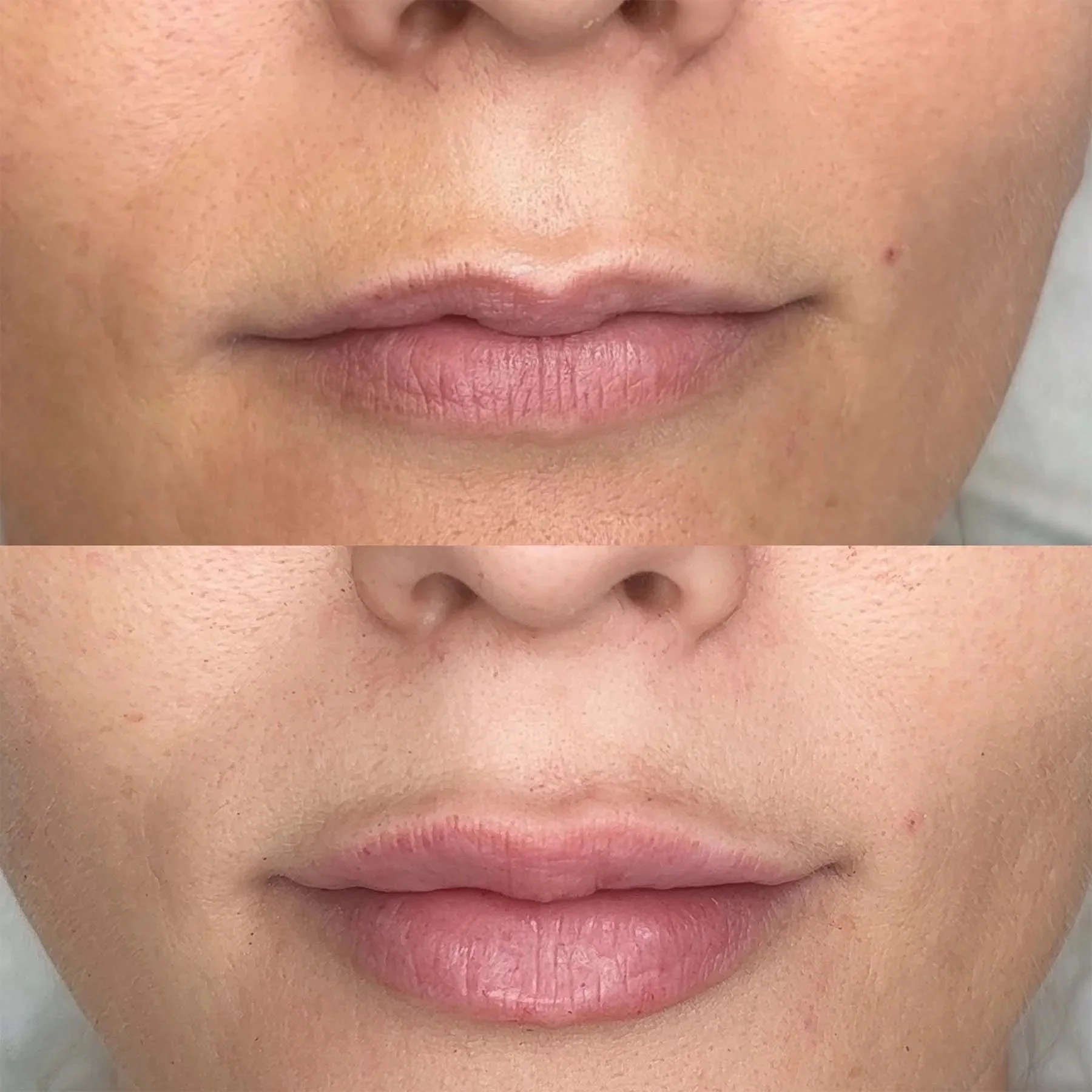 lip-filler-3-skn-plus-in-stone-near-stafford-and-stoke-on-trent-staffordshire.jpg