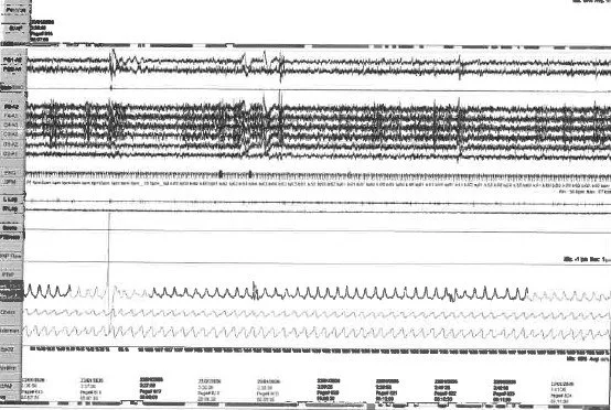 Descifrando el idioma oculto de mi polisomnografía 