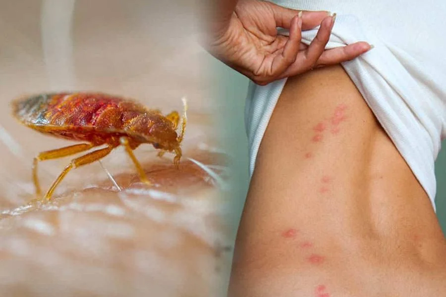 Punture di cimice del letto sulla pelle umana – sintomi tipici di infestazione domestica e metodi efficaci per eliminare le cimici con insetticidi, trappole e trattamenti professionali.