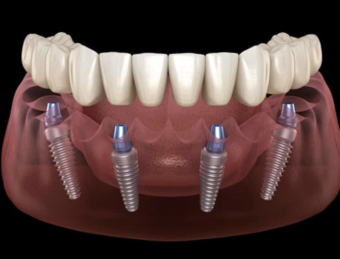 Digital illustration of a mouth with dental implants, including screws and a pink gum line, with upper teeth visible.