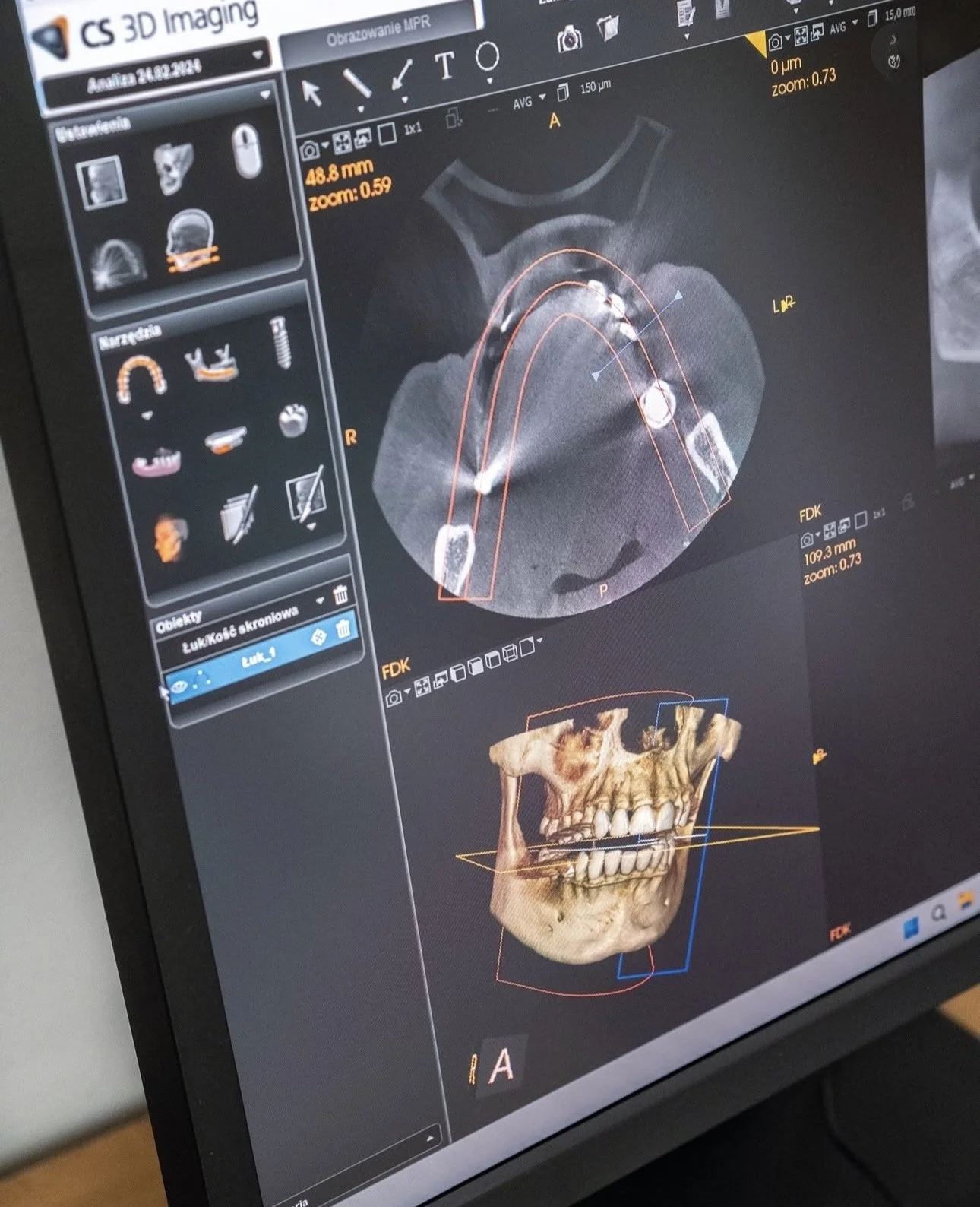 A digital scan of a dental X-ray display showing a 3D image of a skull, including the teeth and jawbone. The screen displays various measurement data and 3D modeling tools used in dental imaging.