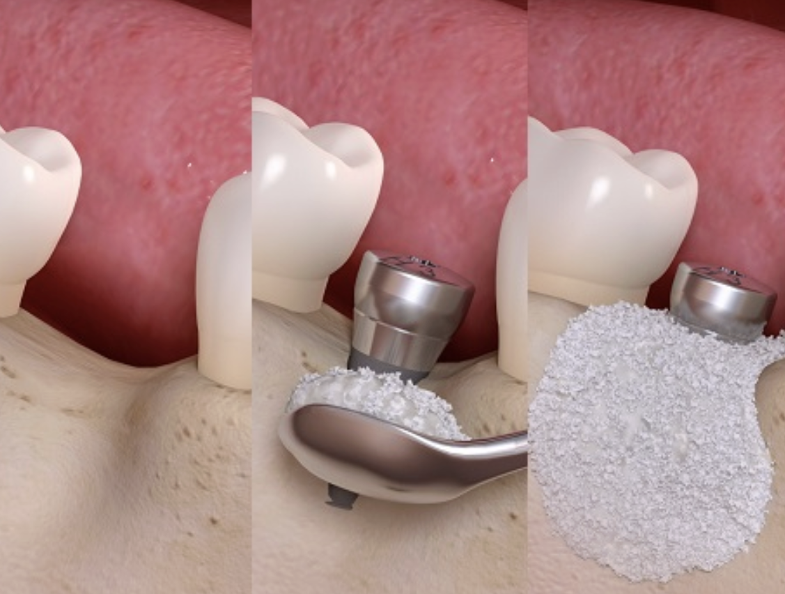 Close-up illustration of a dental procedure involving teeth, with a dental drill, a spoon, and a pile of dental powder, demonstrating tooth cleaning or treatment.