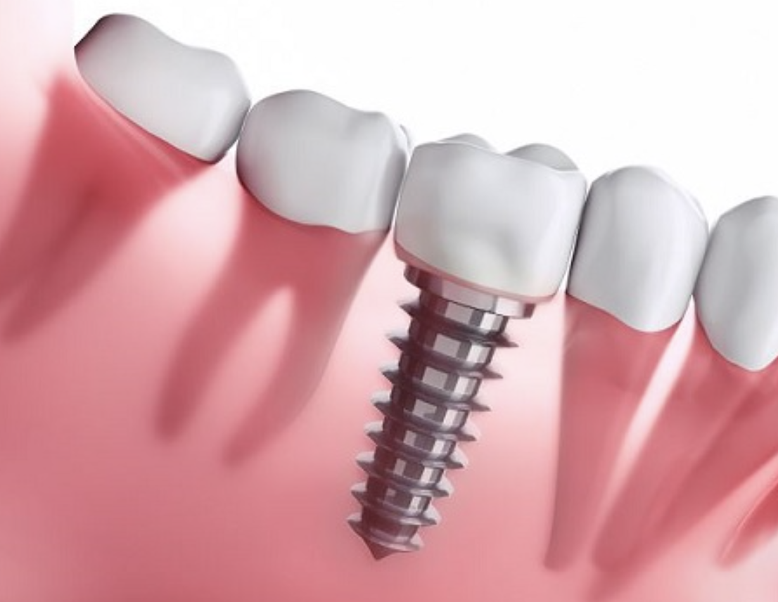 Close-up of a dental implant with a crown, replacing a missing tooth in the gum.