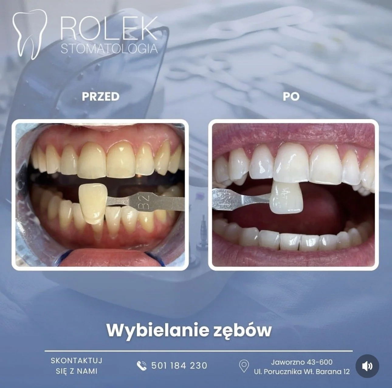 Comparison of teeth before and after teeth whitening at a dental clinic, with a tooth shade guide in the mouth, promoting dental whitening services.