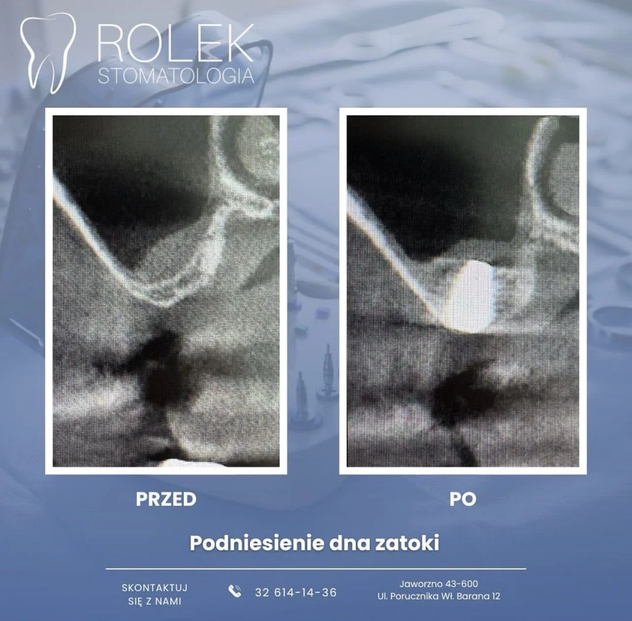 Comparison of a person's nose and face before and after sinus lift surgery, with text in Polish indicating 'Before' and 'After' and contact information for a dental clinic.