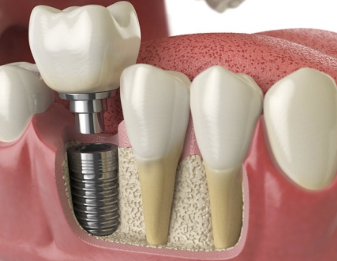 Close-up of a dental implant with a crown, surrounded by natural teeth and pink gum tissue.