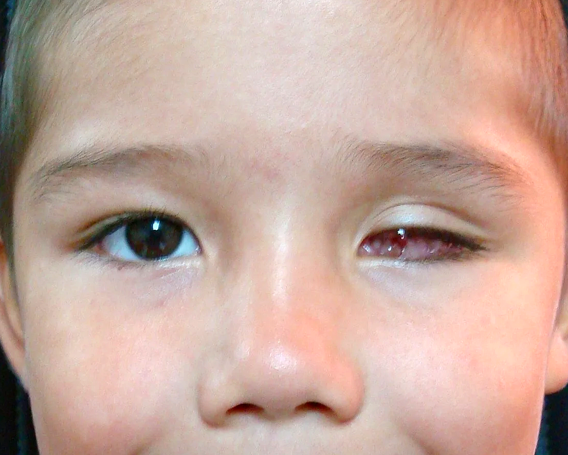 Primer plano del rostro de un niño con un ojo abierto y otro cerrado, con expresión de incomodidad o enfermedad en el ojo cerrado.