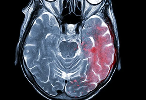 Acquired Brain Injury Training