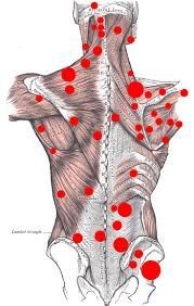 Trigger Points: The Hidden Knots Behind Your Pain