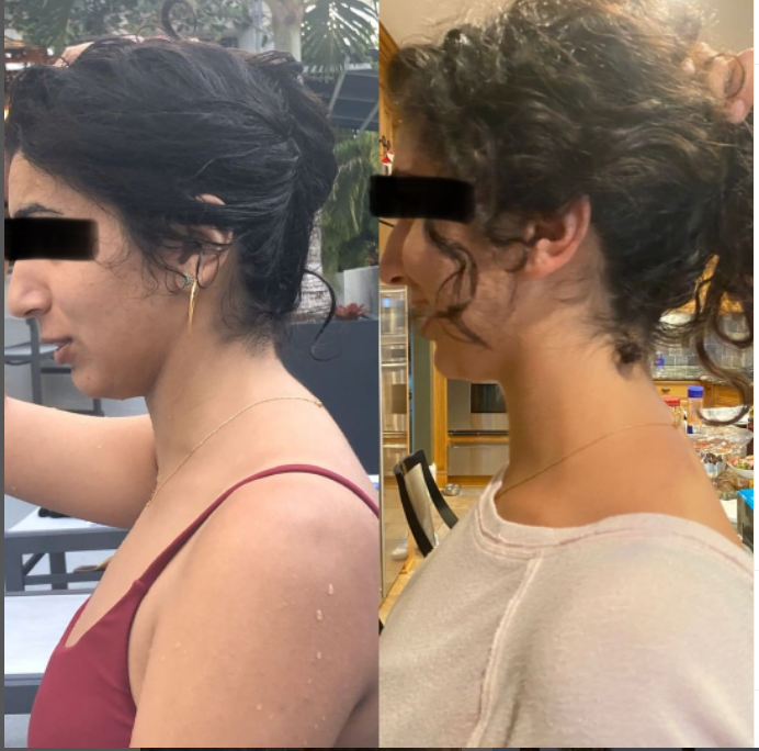 The Dreaded Lower Neck Hump - Dowager’s Hump 