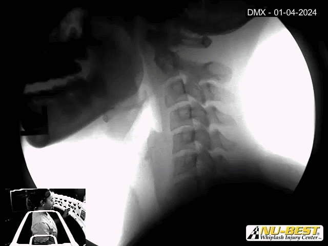 MRI After a Car Accident